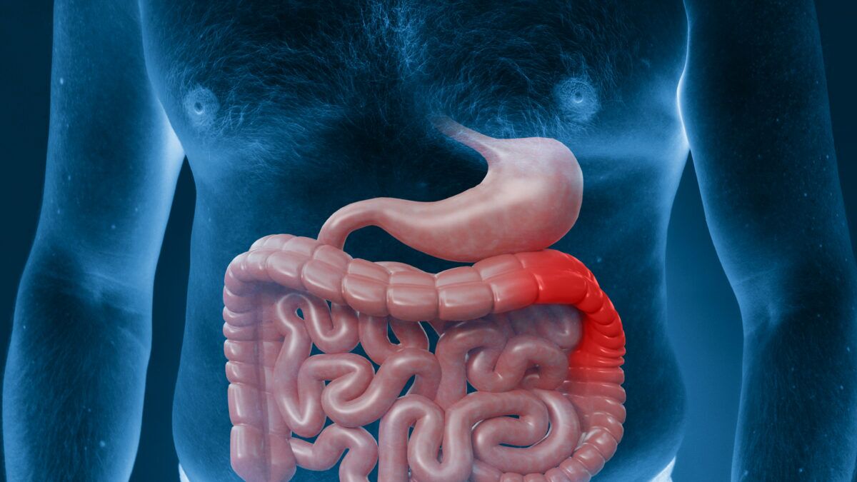 Chẩn Đoán Bệnh Crohn: Nguyên Nhân, Triệu Chứng và Điều Trị Hiệu Quả